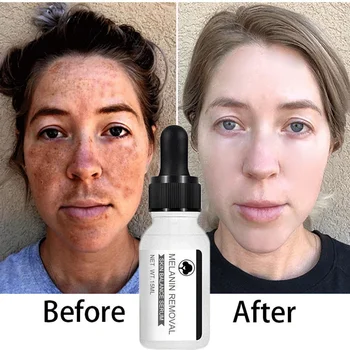 Ниацинамид серум Премахване на тъмни петна Избелване на влага Мощно отстраняване Melasma Chloasma Black Freckle Крем за грижа за кожата на лицето